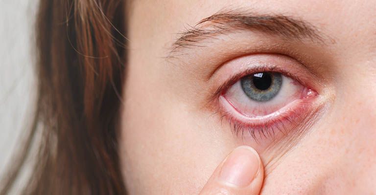 What is Blepharitis